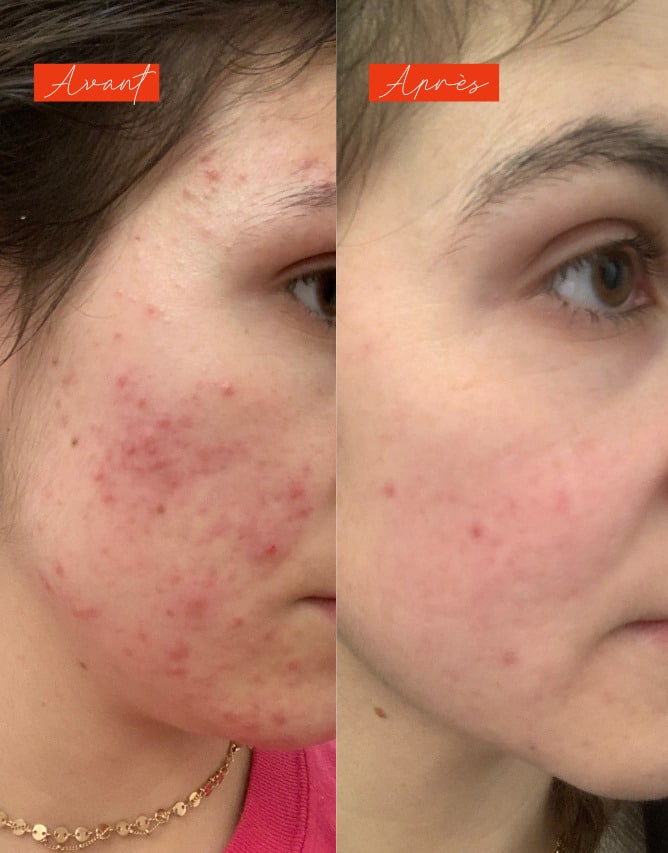 Lundi matin - Actif anti imperfections