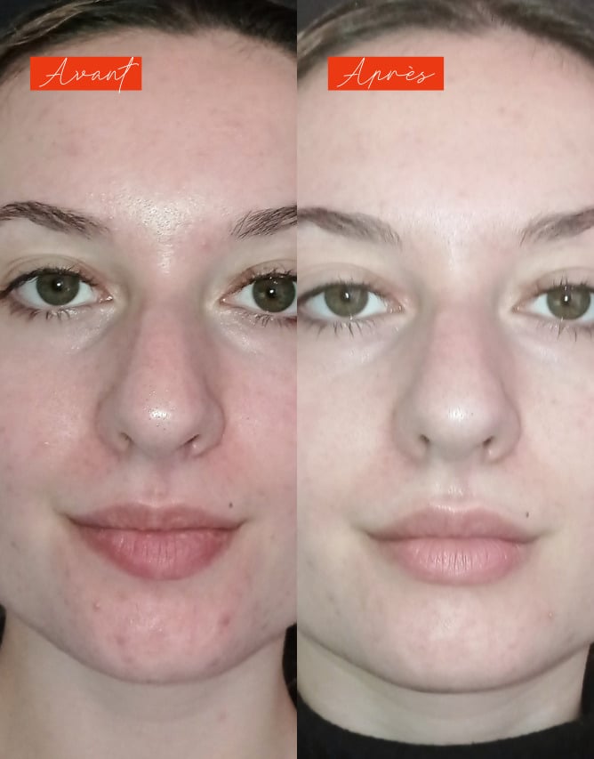 Routine peau grasse à imperfections