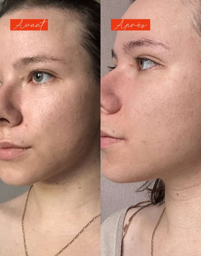 Routine peau grasse à imperfections