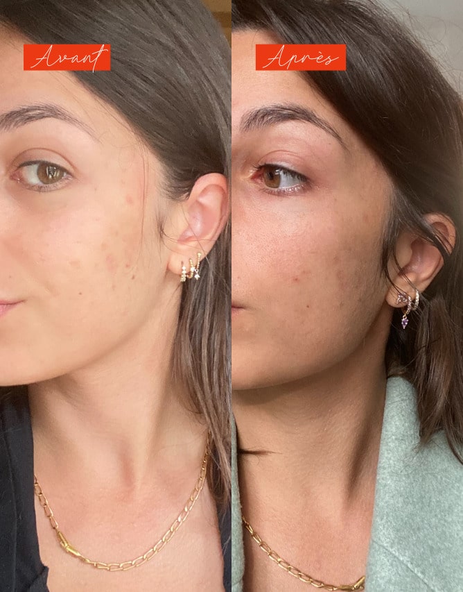 Routine peau à imperfections et taches
