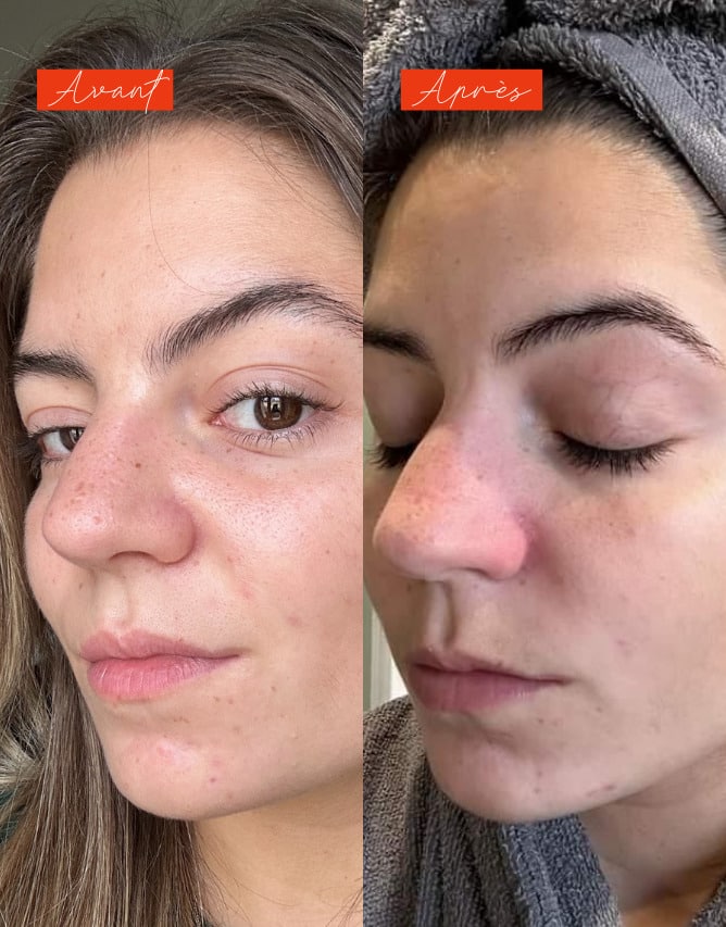 Routine peau grasse à imperfections