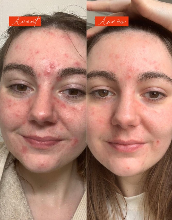 Routine peau sèche à imperfections