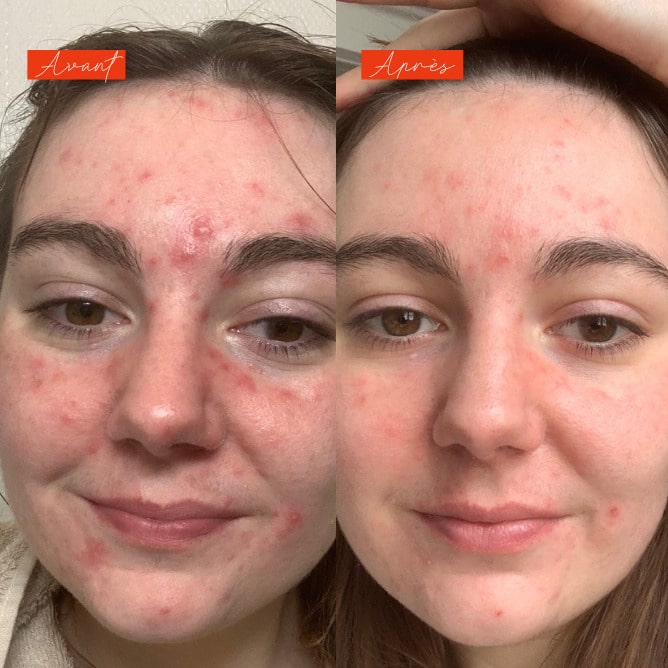 Lundi matin - Actif anti imperfections