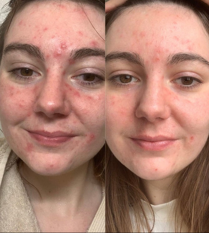 Routine peau à imperfections et taches